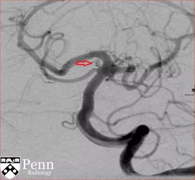 【病例】动脉瘤性蛛网膜下腔出血1例 【病例】动脉瘤性蛛网膜下腔出血1例