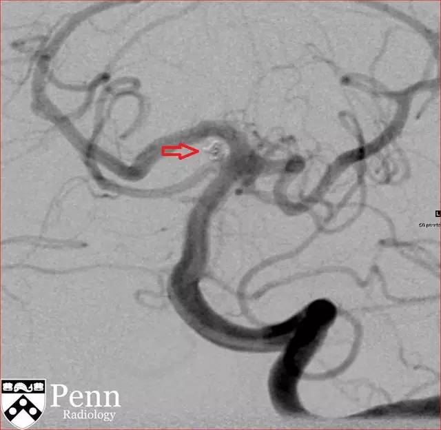 【病例】动脉瘤性蛛网膜下腔出血1例 【病例】动脉瘤性蛛网膜下腔出血1例