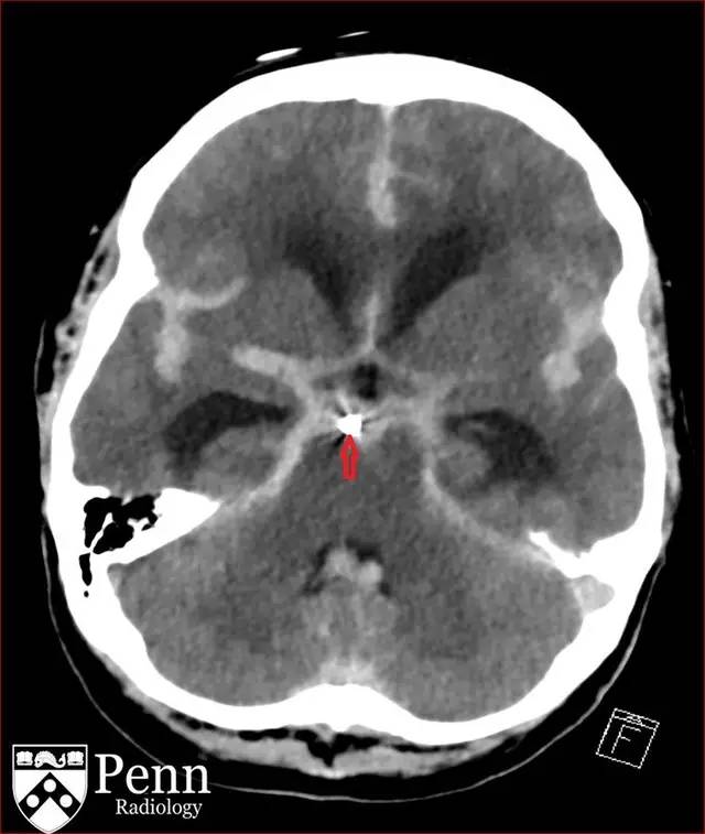 【病例】动脉瘤性蛛网膜下腔出血1例 【病例】动脉瘤性蛛网膜下腔出血1例