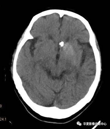【病例】非酮症高血糖合并偏侧舞蹈症1例CT影像表现
