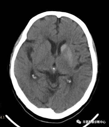 【病例】非酮症高血糖合并偏侧舞蹈症1例CT影像表现