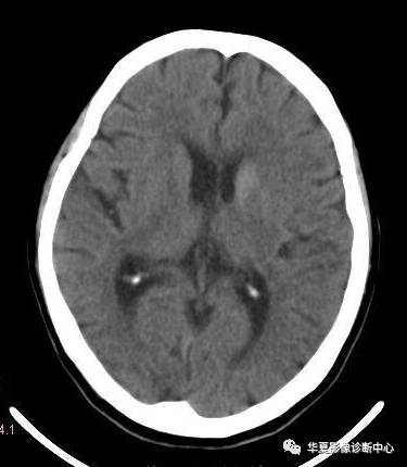 【病例】非酮症高血糖合并偏侧舞蹈症1例CT影像表现
