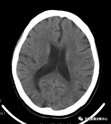 【病例】非酮症高血糖合并偏侧舞蹈症1例CT影像表现