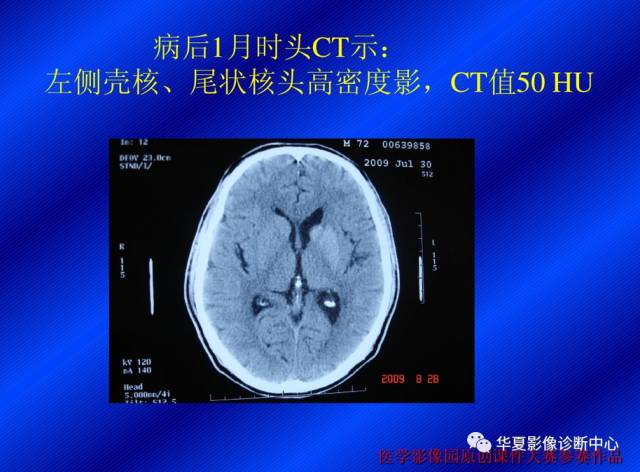 【病例】非酮症高血糖合并偏侧舞蹈症1例CT影像表现