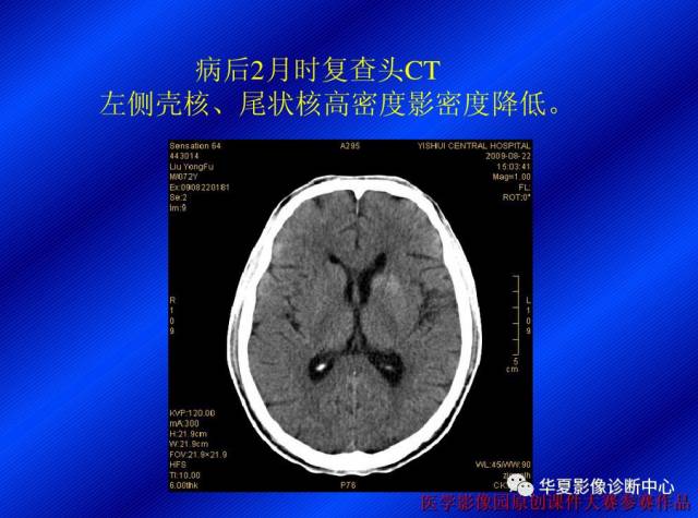 【病例】非酮症高血糖合并偏侧舞蹈症1例CT影像表现