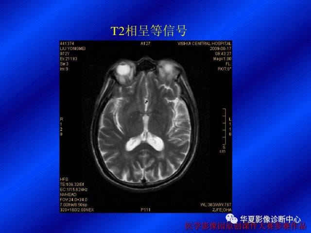 【病例】非酮症高血糖合并偏侧舞蹈症1例CT影像表现