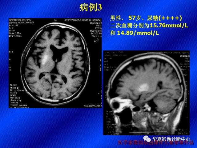 【病例】非酮症高血糖合并偏侧舞蹈症1例CT影像表现