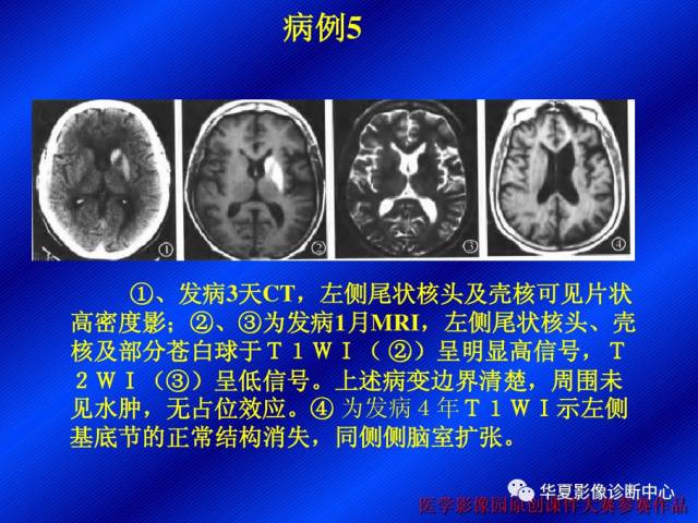 【病例】非酮症高血糖合并偏侧舞蹈症1例CT影像表现