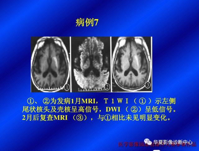 【病例】非酮症高血糖合并偏侧舞蹈症1例CT影像表现