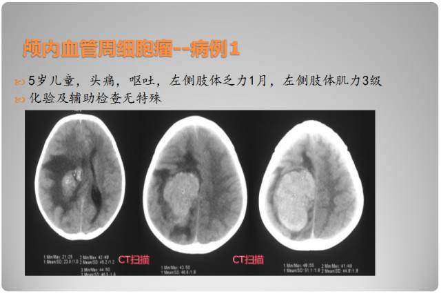 【PPT】颅内血管周细胞瘤