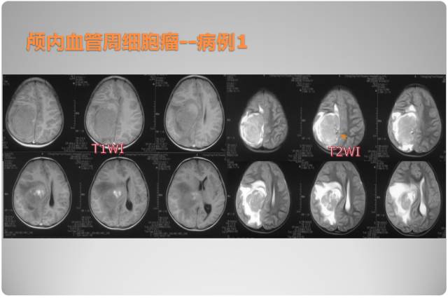 【PPT】颅内血管周细胞瘤