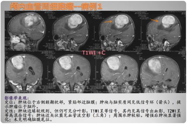 【PPT】颅内血管周细胞瘤