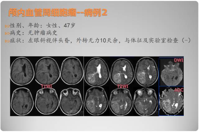 【PPT】颅内血管周细胞瘤