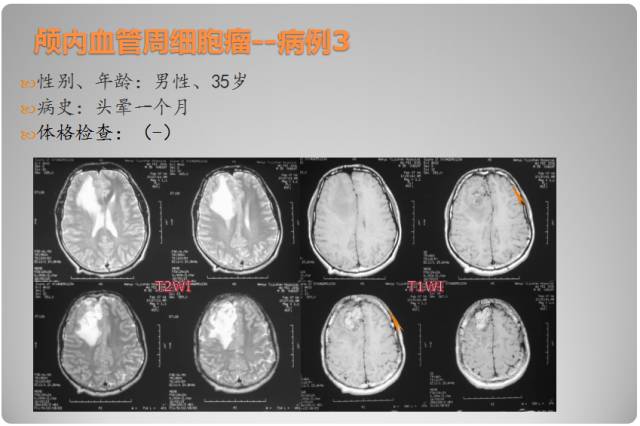 【PPT】颅内血管周细胞瘤