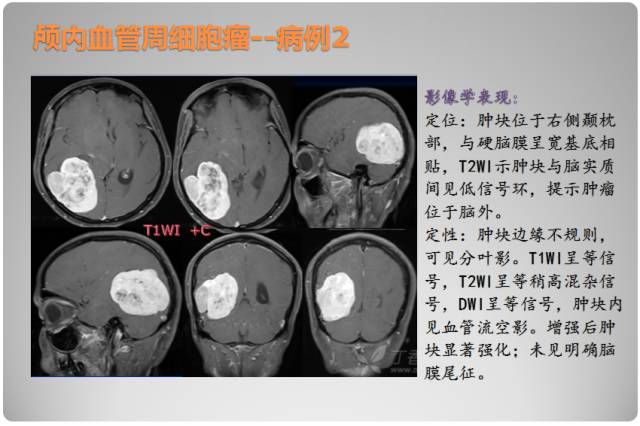 【PPT】颅内血管周细胞瘤