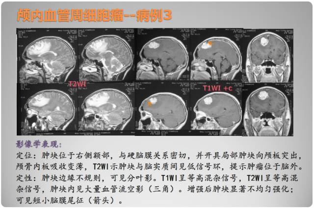 【PPT】颅内血管周细胞瘤