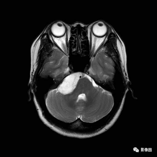 【病例】桥小脑脚区表皮样囊肿1例MR影像表现