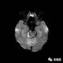 【病例】桥小脑脚区表皮样囊肿1例MR影像表现