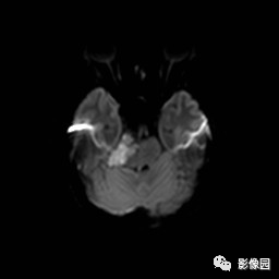 【病例】桥小脑脚区表皮样囊肿1例MR影像表现