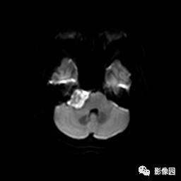 【病例】桥小脑脚区表皮样囊肿1例MR影像表现