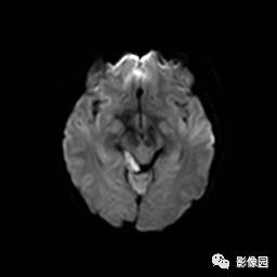 【病例】桥小脑脚区表皮样囊肿1例MR影像表现