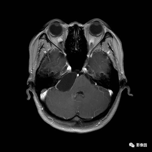 【病例】桥小脑脚区表皮样囊肿1例MR影像表现