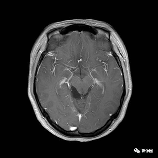 【病例】桥小脑脚区表皮样囊肿1例MR影像表现