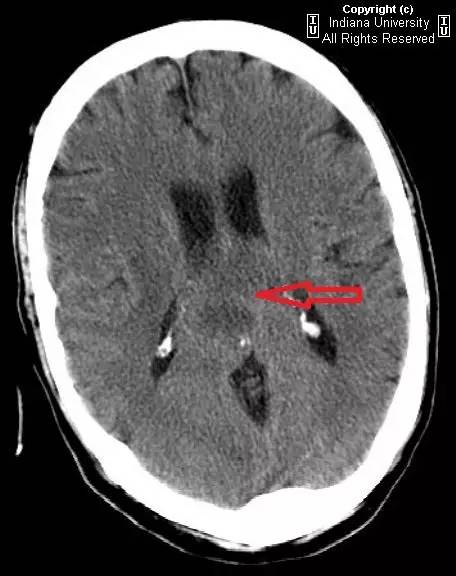 【病例】胶质母细胞瘤1例CT及MR影像表现