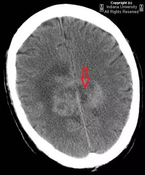 【病例】胶质母细胞瘤1例CT及MR影像表现