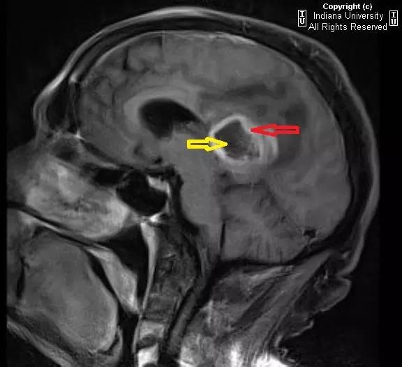 【病例】胶质母细胞瘤1例CT及MR影像表现