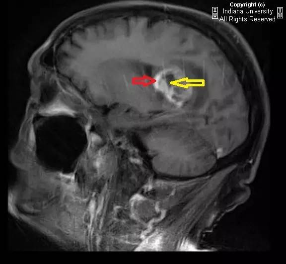 【病例】胶质母细胞瘤1例CT及MR影像表现