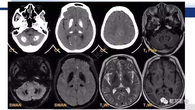 【PPT】Fahr's综合征