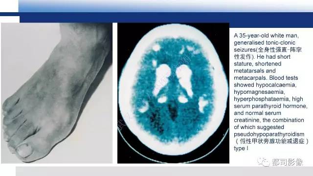 【PPT】Fahr's综合征