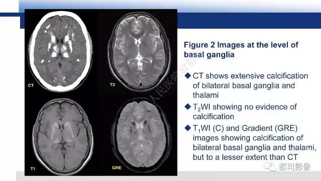 【PPT】Fahr's综合征