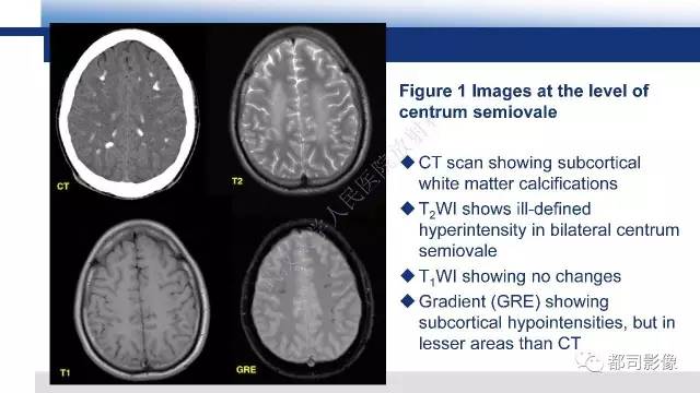 【PPT】Fahr's综合征