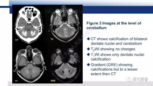 【PPT】Fahr's综合征