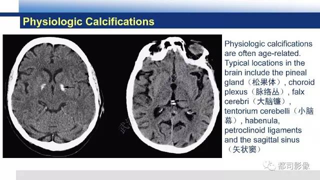 【PPT】Fahr's综合征
