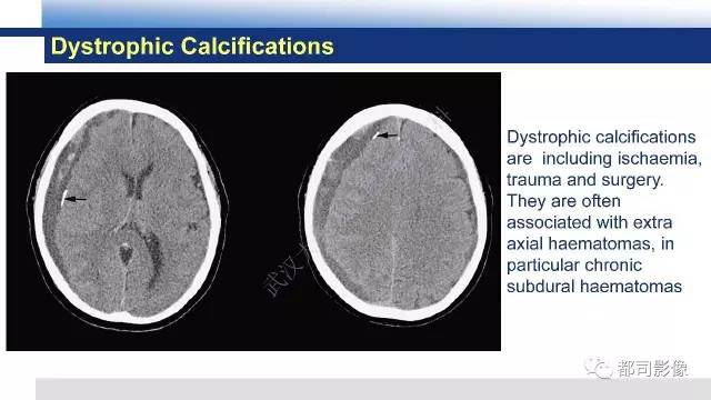 【PPT】Fahr's综合征