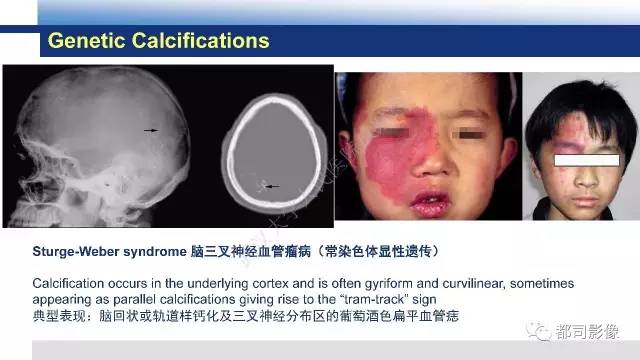 【PPT】Fahr's综合征