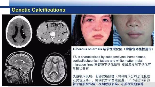 【PPT】Fahr's综合征