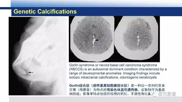 【PPT】Fahr's综合征