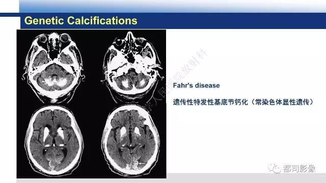 【PPT】Fahr's综合征