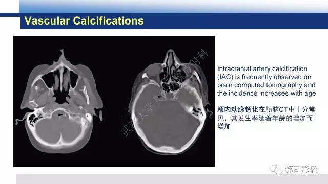 【PPT】Fahr's综合征