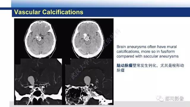 【PPT】Fahr's综合征