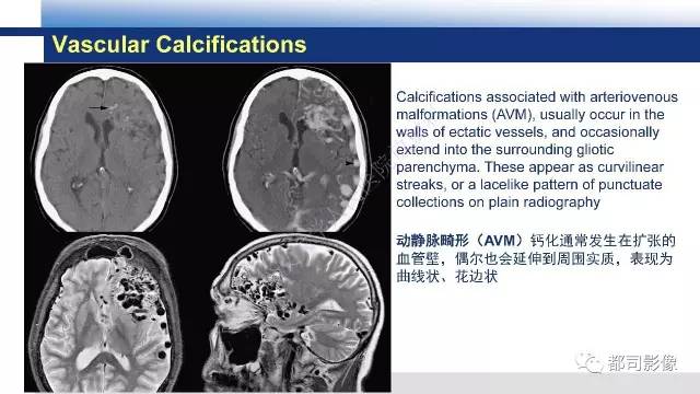【PPT】Fahr's综合征