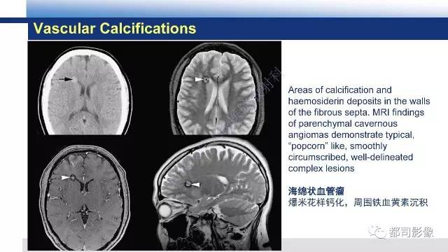 【PPT】Fahr's综合征