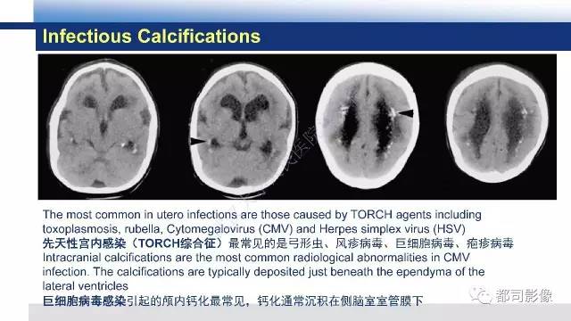 【PPT】Fahr's综合征