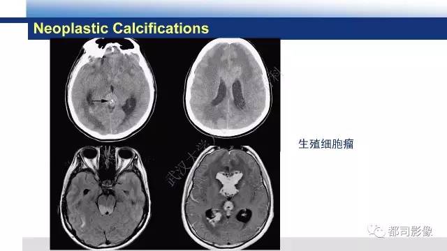【PPT】Fahr's综合征