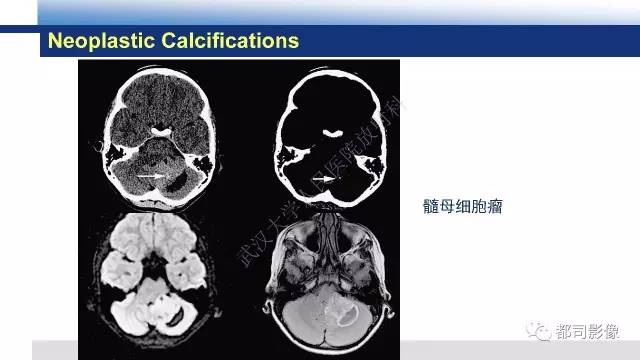 【PPT】Fahr's综合征