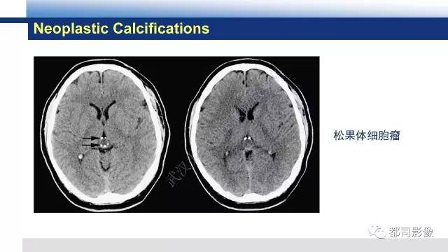 【PPT】Fahr's综合征